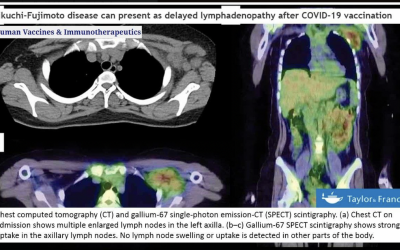 Malattia di Kikuchi-Fujimoto come linfoadenopatia dopo la vaccinazione COVID-19