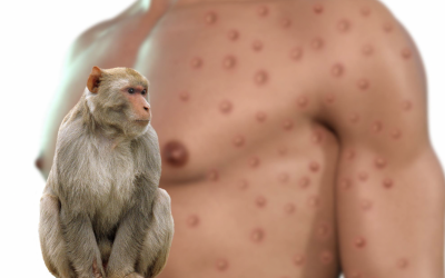 Vaiolo delle scimmie: in Lombardia pronta la task force, in arrivo i vaccini